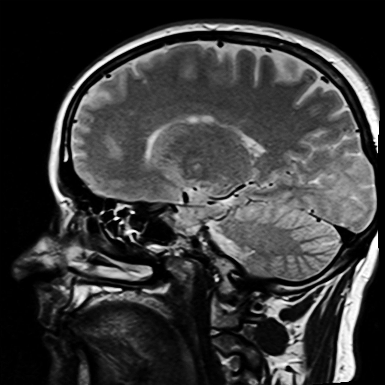 TMS Therapy Explained